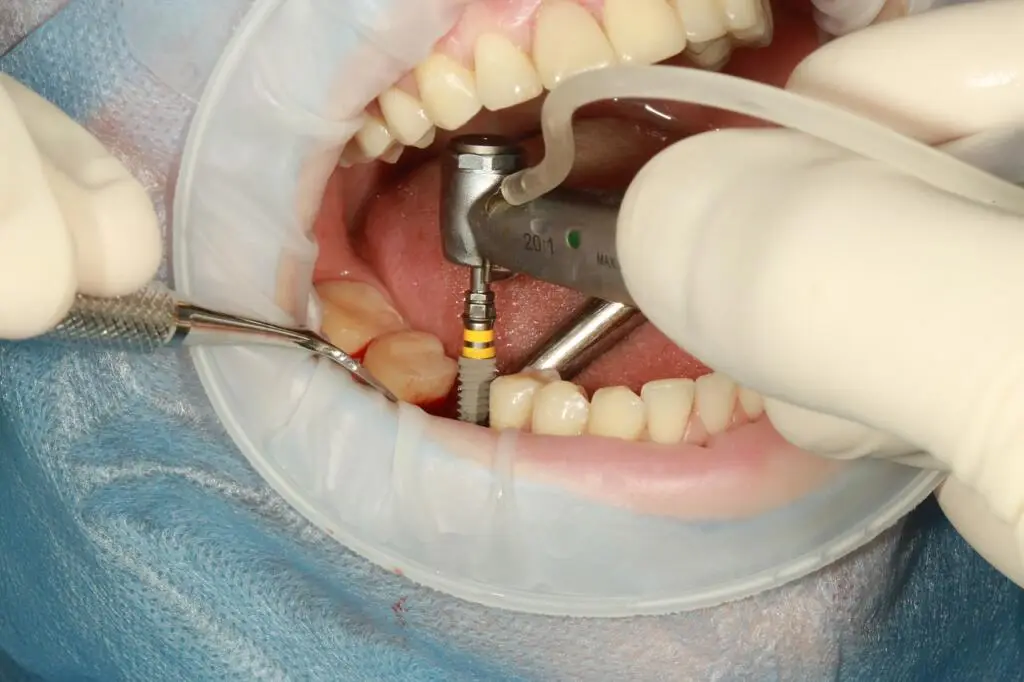 Dentista poniendo aun paciente un implante dental de Zirconio