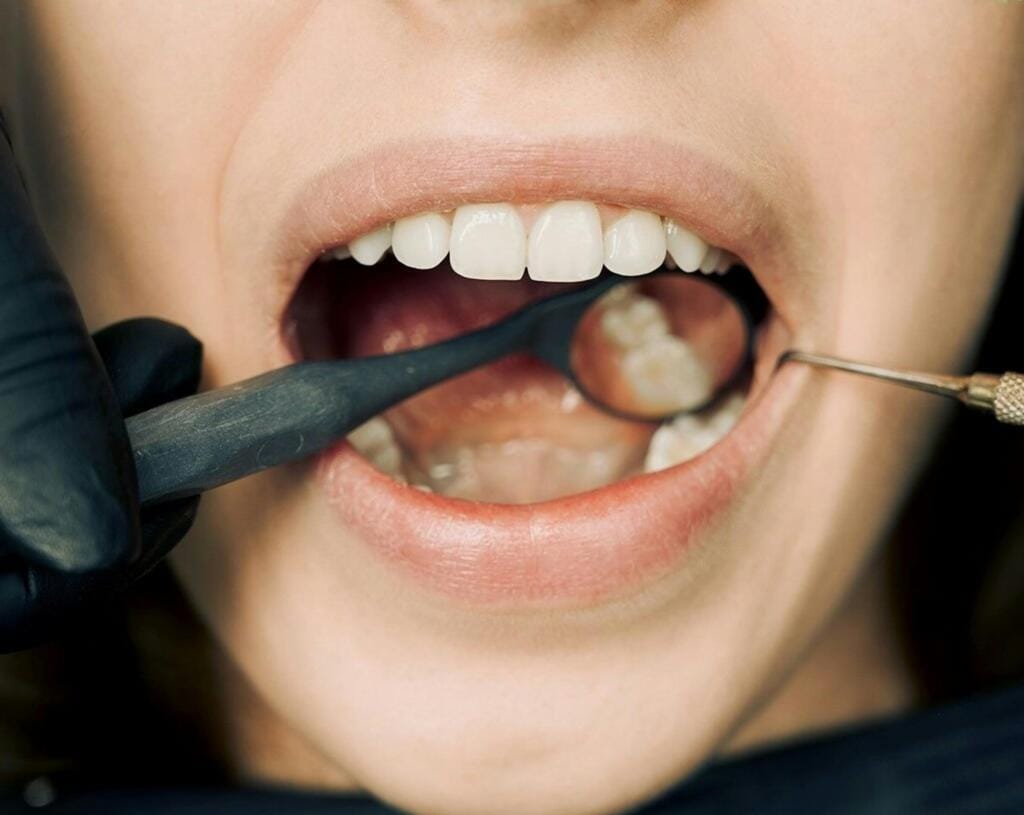 PACIENTE CON TRISMUS DENTAL, consulta en nuestra clinica dental en Vilafranca del Penedes