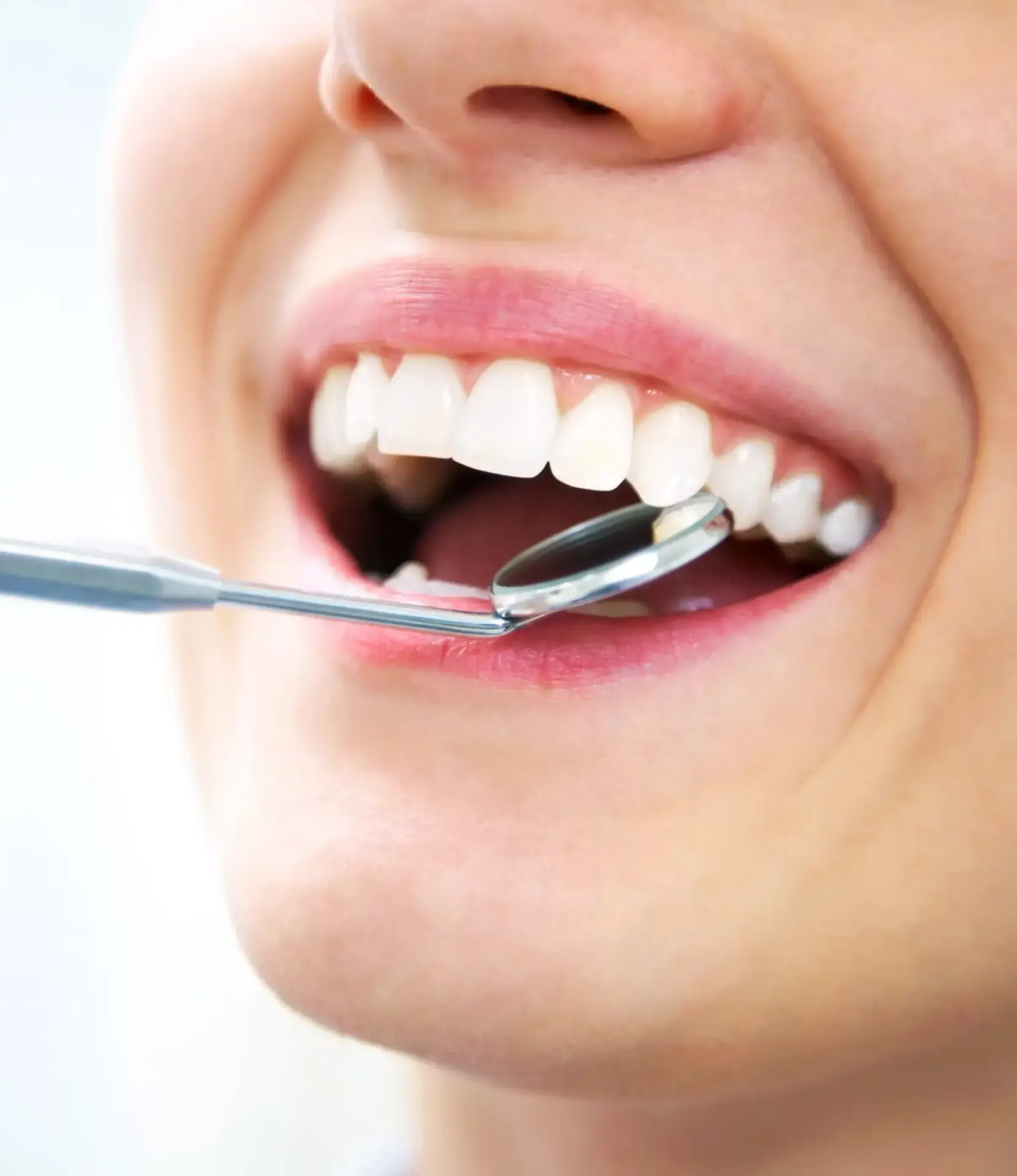 Blanqueamiento dental