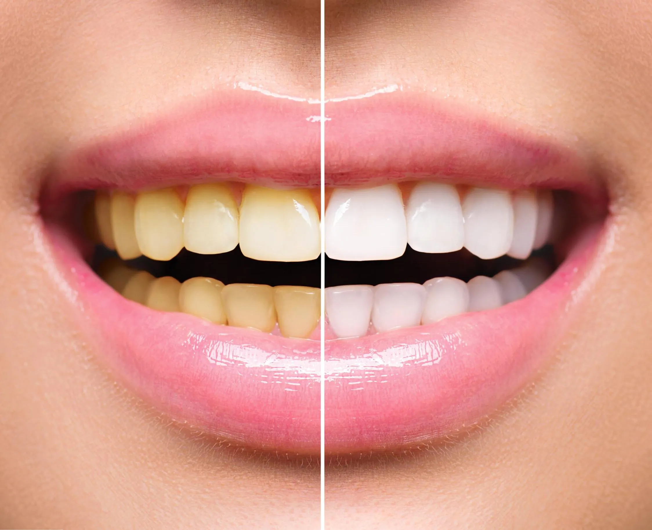Resultados antes y después de un blanqueamiento dental con láser en SDS Dental Clinic