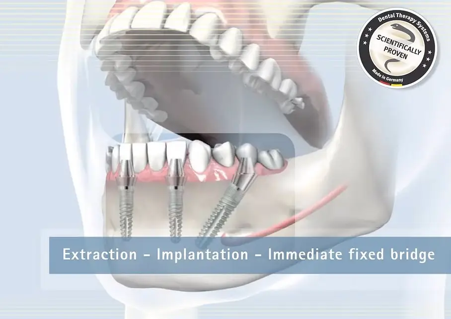 ilustracion con implantes en 1 día en SDS dentista Vilafranca