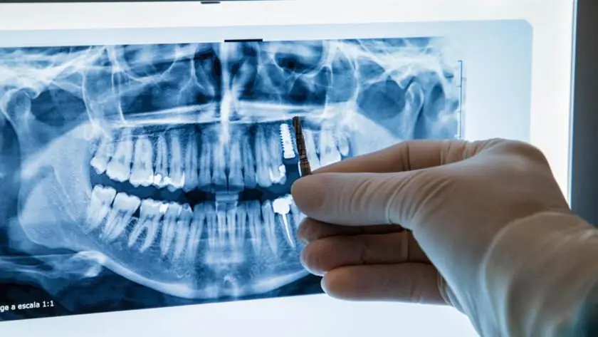 implantes dentales premium Bredent en SDS Clinia dental en Vilafranca del Penedes