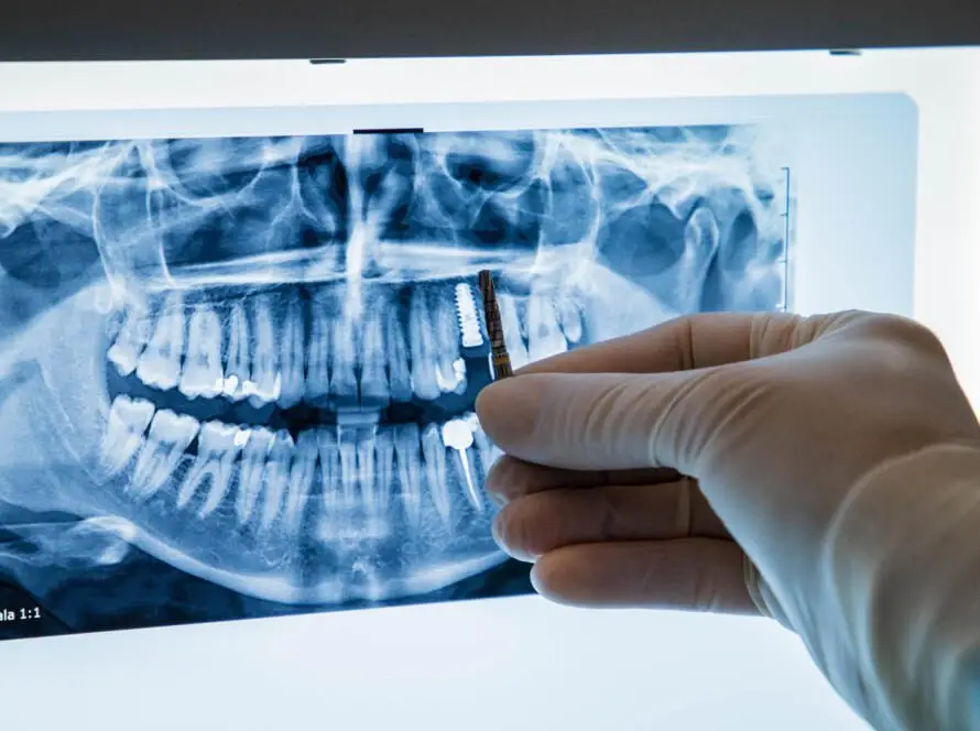 implantes dentales premium Bredent en SDS Clinia dental en Vilafranca del Penedes