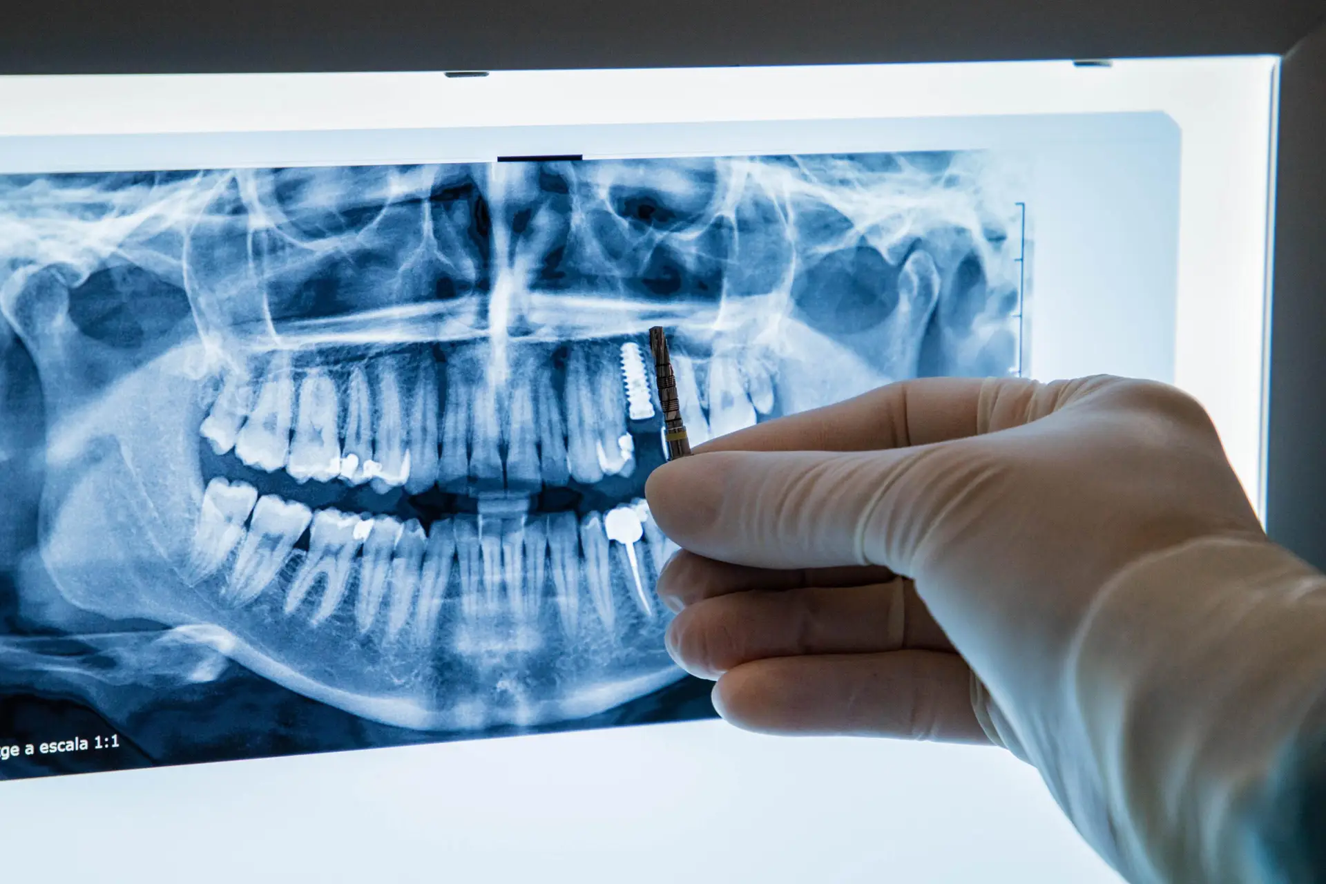 Implants dentals