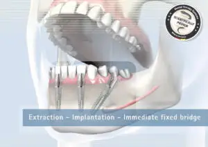 Ilustración de una arcada dental completa sobre implantes