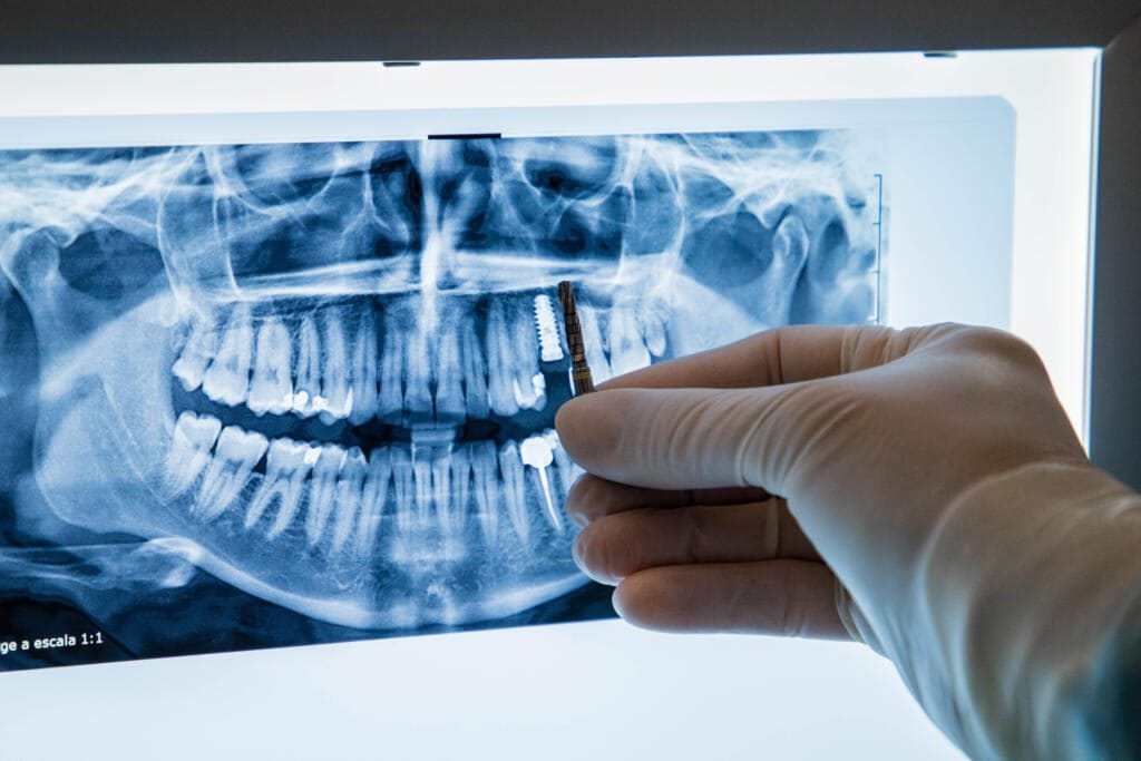 implantes dentales Vilafranca en SDS Dental Clinic