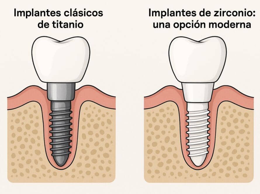tipos de implantes dentales Vilafranca en SDS Dental Clinic