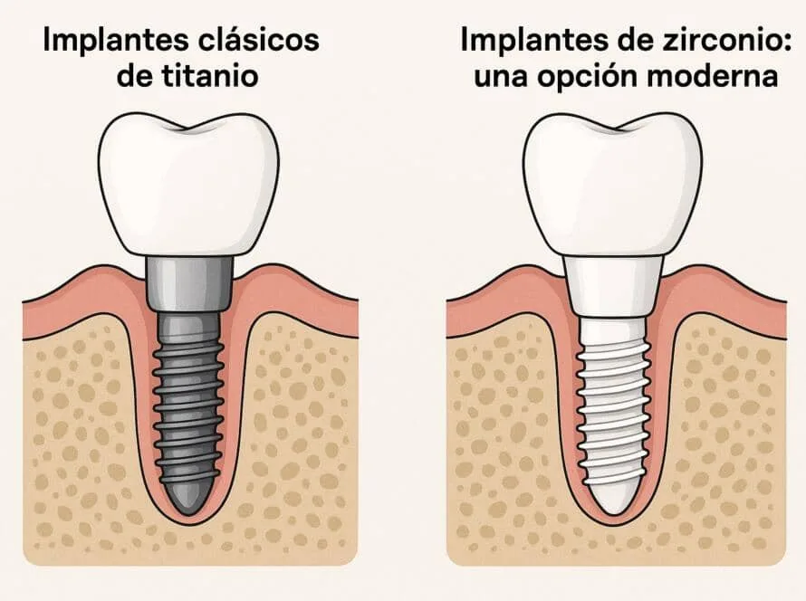 tipos de implantes dentales Vilafranca en SDS Dental Clinic